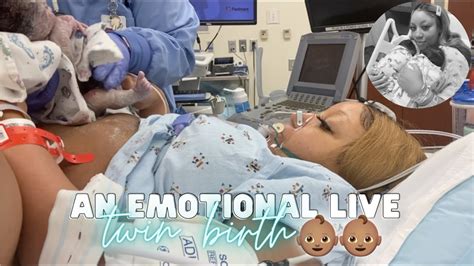 Twin birth video: Watch live delivery of twins 